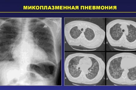 Пневмотест на микроплазменную инфекцию запущен в Нижнем Новгороде